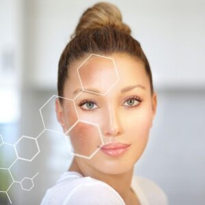 melasma